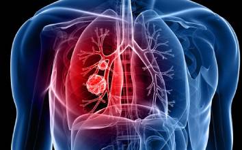 New Project 58 - Καρκίνος του πνεύμονα. Πώς αντιμετωπίζεται;